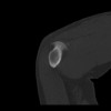 SPORK, NICO - 22.03.1976 - 02.08.2022 - CT obere Extremität - 17:59:07